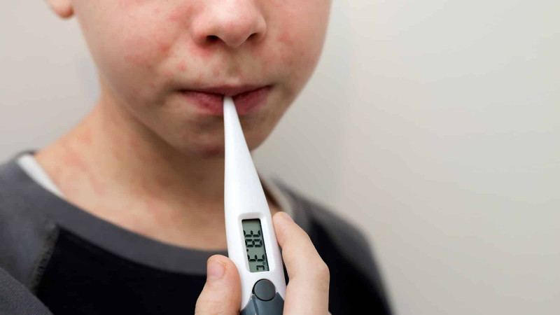 Xaçmazda 21 nəfər qızılcaya yoluxub