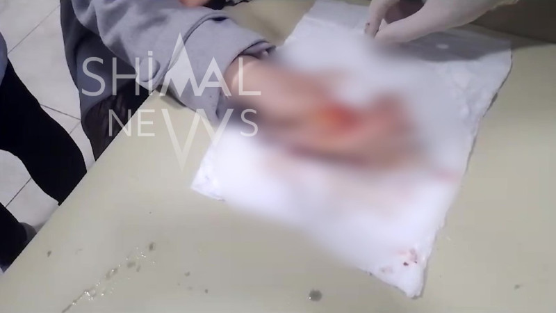 Xaçmazlının barmağından üzük kəsilərək çıxarıldı - VİDEO