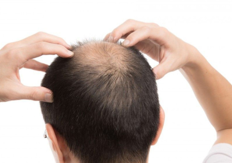 Saçı tökülənlərin ən çox olduğu bölgələr - Şəki, Zaqatala, Balakən