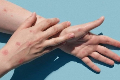 Azərbaycanda meymunçiçəyinə yoluxma halı qeydə alınmayıb
