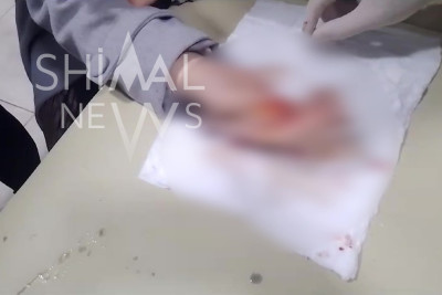 Xaçmazlının barmağından üzük kəsilərək çıxarıldı - VİDEO